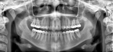 X-Ray Dental